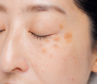 ナイアシンアミドとは？